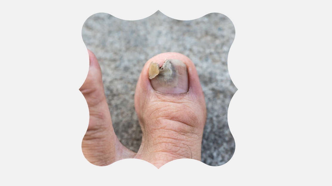 Kynsisieni on yleinen kynsien infektiotila, joka näkyy kynnen paksuuntumisena, värimuutoksina ja murenevuutena. Jalkaterapiassa hoitoon kuuluu kynnen mekaaninen ohennus sekä omahoito-ohjaus, joilla pyritään hillitsemään infektiota ja tukemaan terveen kynnen kasvua.