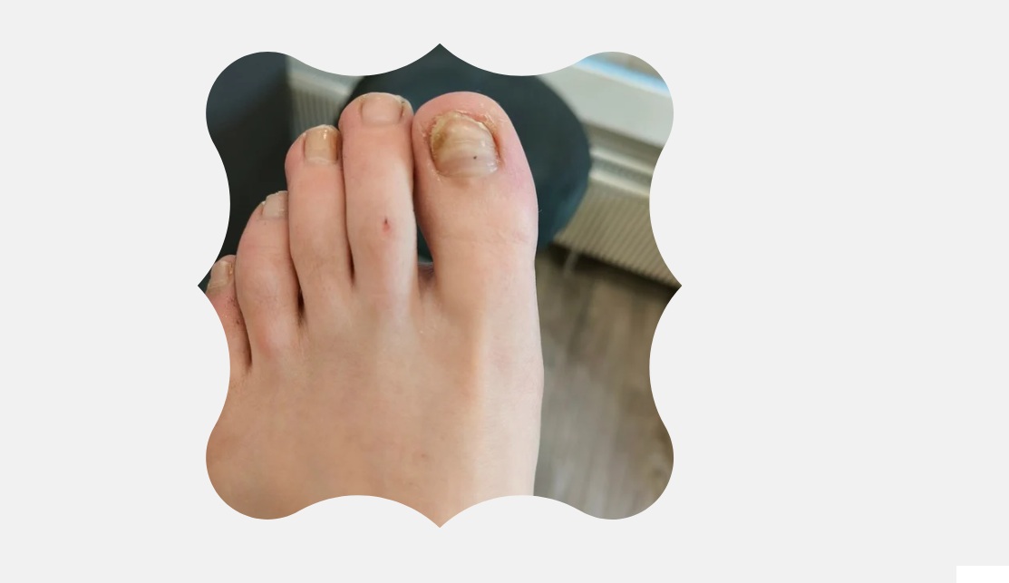 Traumakynsi syntyy kynteen kohdistuneen iskun, puristuksen tai pitkäaikaisen toistuvan rasituksen seurauksena. Kynsi voi muuttua paksuksi, väriltään tummaksi, irrota osittain tai kasvaa virheasentoon. Jalkaterapiassa traumakynnen hoitoon kuuluu kynnen ohennus ja hoito, kivun lievitys sekä ohjaus kynnen suojaukseen ja oikeanlaiseen omahoitoon. Tarvittaessa voidaan arvioida myös kynsiproteesin tarve.