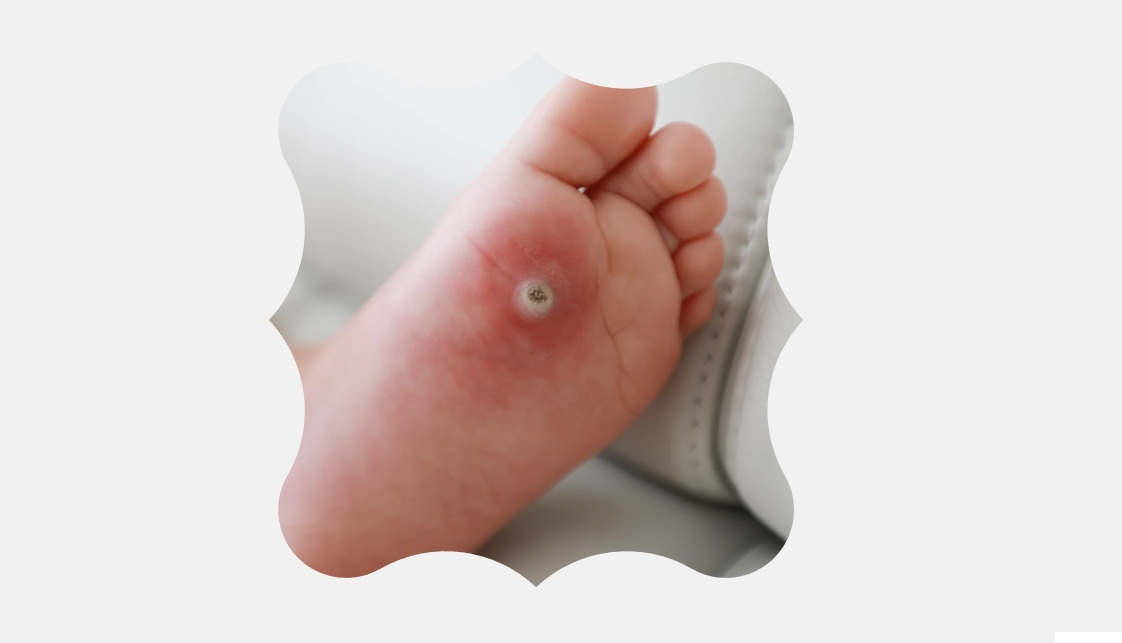 Syylät ovat viruksen aiheuttamia ihomuutoksia, jotka voivat olla kivuliaita ja häiritä kävelyä. Jalkaterapeutin hoidossa syylää hoidetaan kohdennetusti ja turvallisesti, usein sarjahoitona.