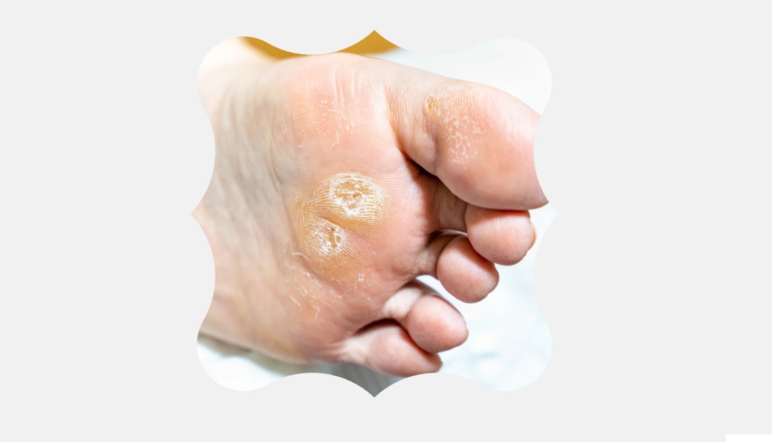 Känsä on paikallinen, usein kivulias ihon paksuuntuma, joka syntyy pitkäaikaisen paineen tai hankauksen seurauksena. Jalkaterapiassa känsä hoidetaan turvallisesti poistamalla kovettunut iho, keventämällä painetta ja ohjaamalla oikeanlaiseen omahoitoon sekä tarvittaessa apuvälineisiin.