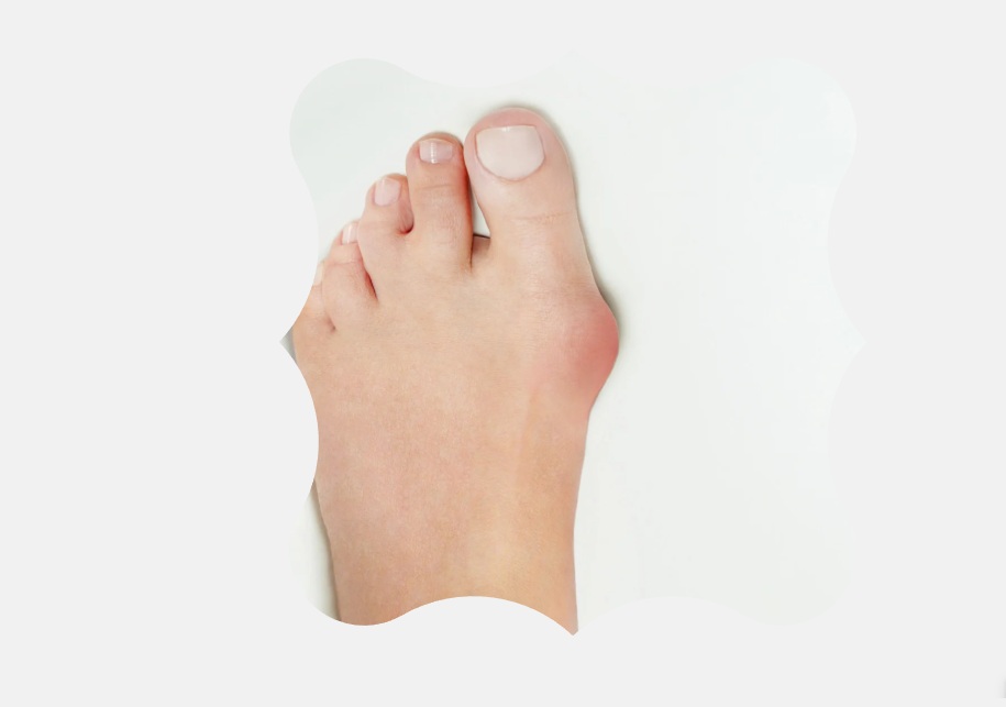 Vaivaisenluu on isovarpaan tyvinivelen virheasento, jossa isovarvas kääntyy kohti muita varpaita ja nivelalue voi kipeytyä. Se voi aiheuttaa kipua, turvotusta, kovettumia ja kuormitusongelmia jalkaterässä. Jalkaterapiassa vaivaisenluun oireita helpotetaan kuormitusta keventämällä, ohjaamalla sopiviin jalkineisiin, tarvittaessa varvasortooseilla sekä yksilöllisillä harjoitteilla.